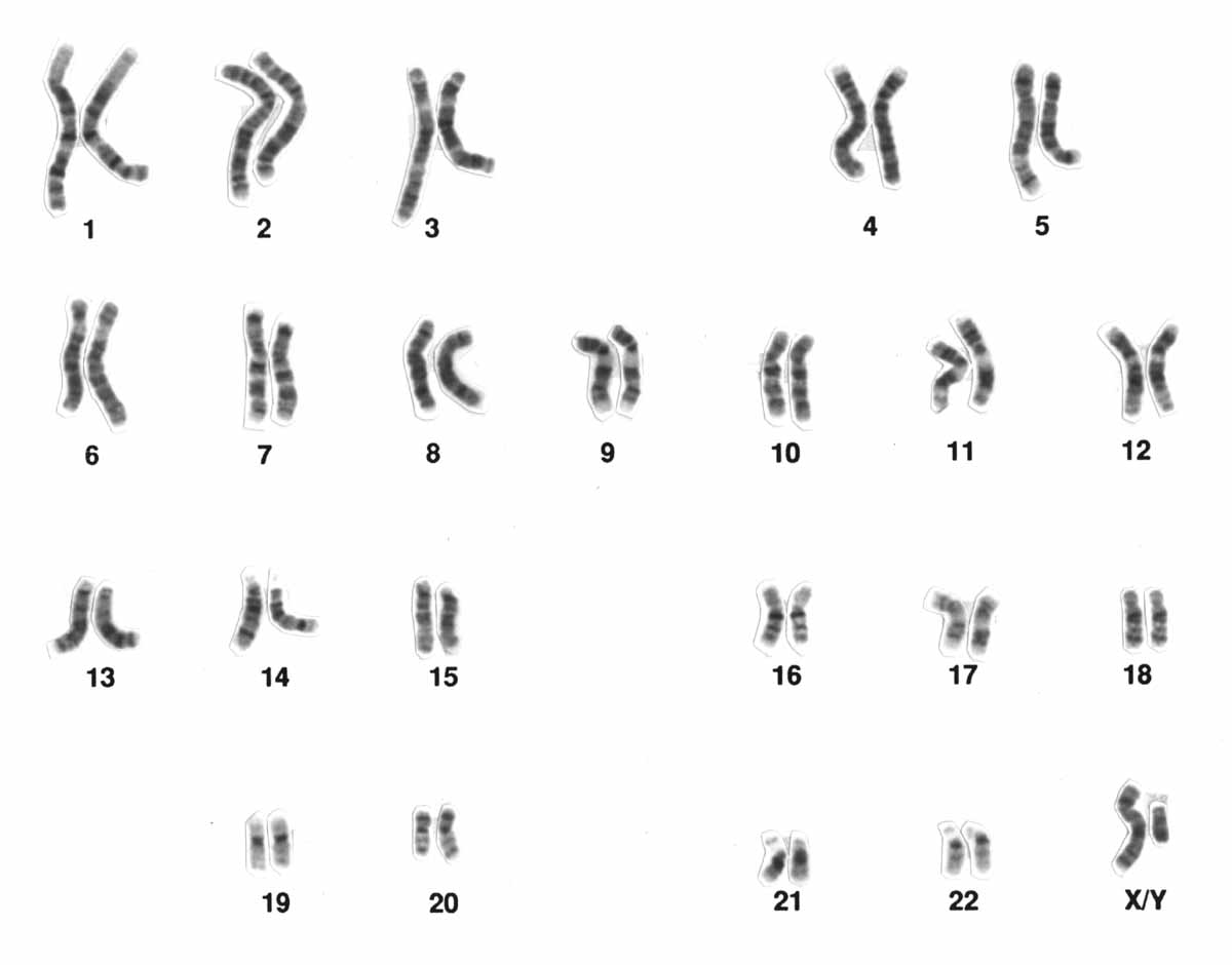 A human male karyotype: 22 numbered pairs of chromosomes plus the X and Y, each banded in dark and light stripes after G-banding staining.